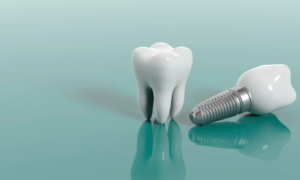 임플란트 종류 가격